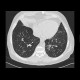 Tree in bud pattern, infectious bronchiolitis: CT - Computed tomography